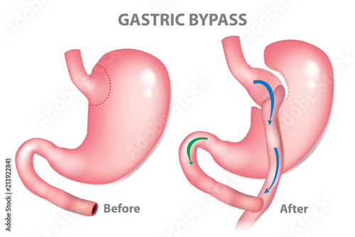 Gastric bypass surgery - RNY (Roux-en-Y ). MINI-GASTRIC BYPASS photo