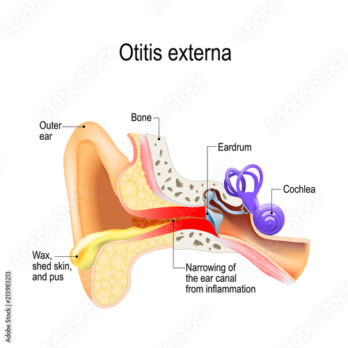 Swimmer's ear. Otitis externa photo