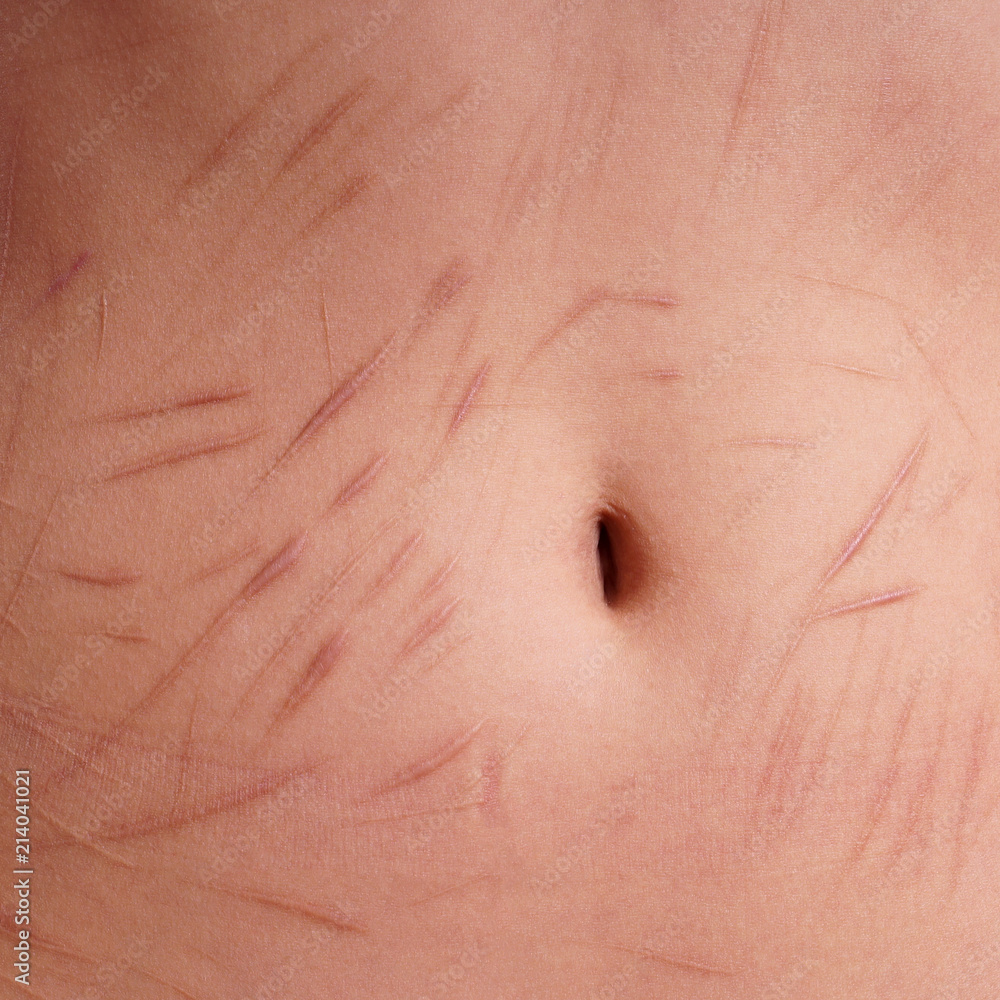 Fototapeta premium belly with scars and cuts from deliberate self-harm