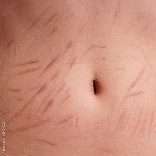 belly with scars and cuts from deliberate self-harm photo