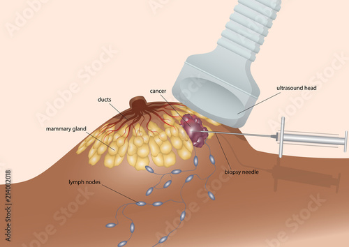 Biopsy the breast cancer cell