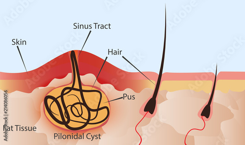 Inflammation in the hair follicle