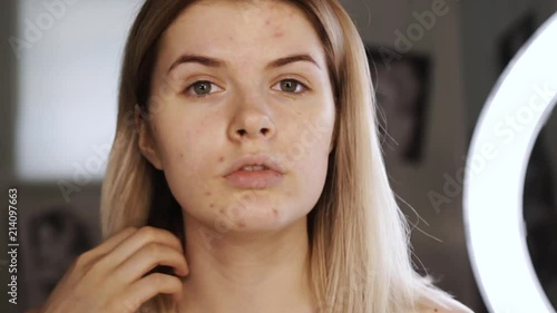 Portrait of a teenager with problem skin, close-up