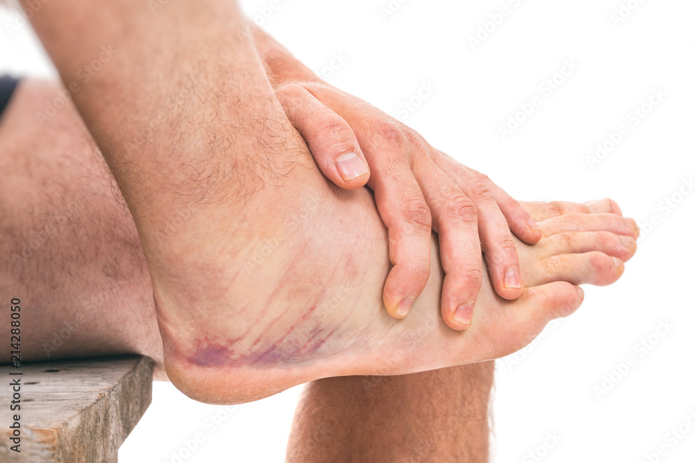 Fototapeta premium Sprained ankle with bruising isolated on white background