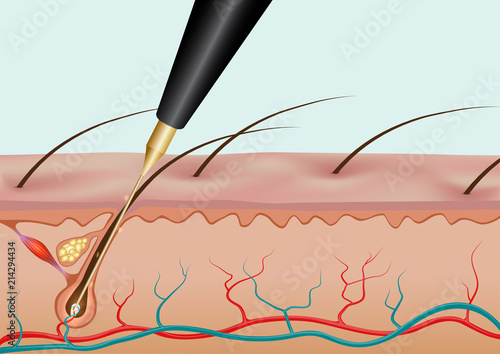 Burning hair root with needle epilation