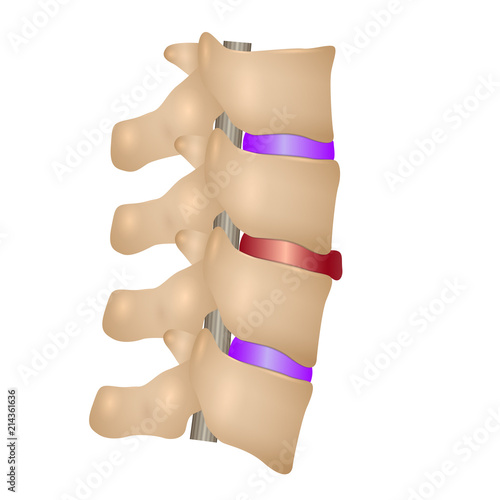 Sliding out the disks in the spine