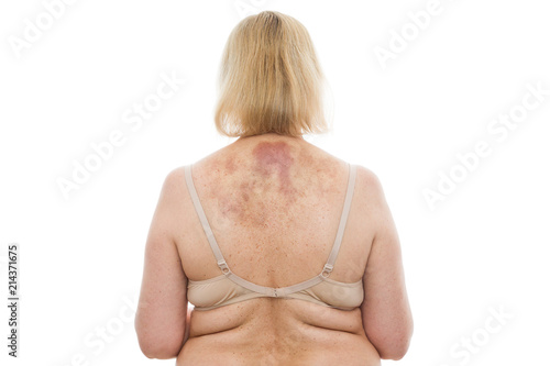 A bruise on the back, a woman with extensive hematoma after a massage photo