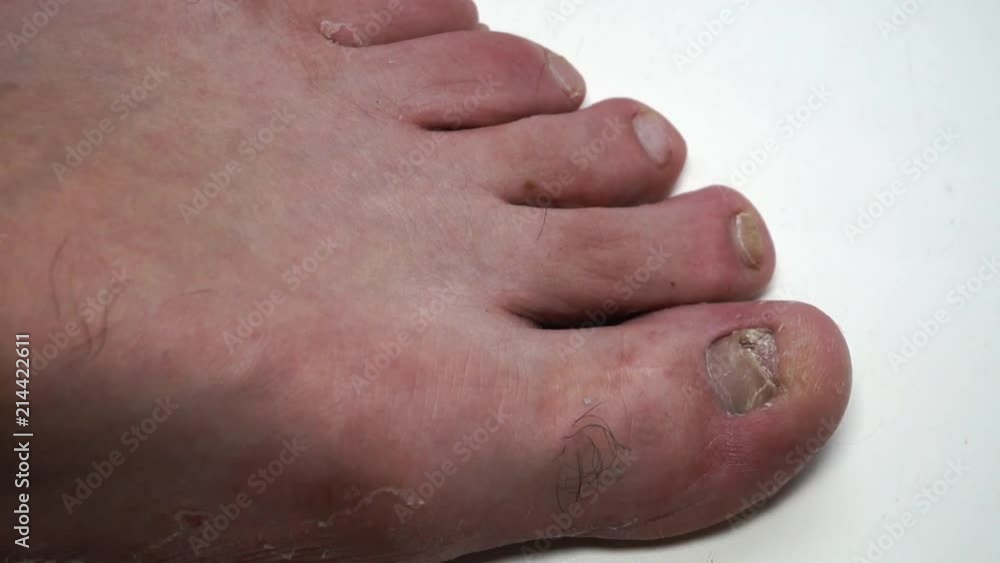 Fungus infection nails of person's foot Fungus infection nails of person's foot