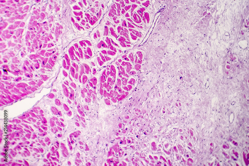 Acute myocardial infarction, histology of heart tissue, light micrograph. Area of infarct is paler than the relatively viable area of heart muscle