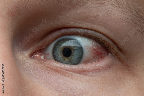 Εκτύπωση καμβά Sick red eye of tired man. close up view