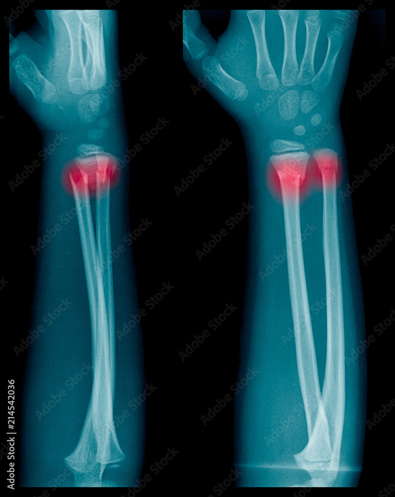 Xray image of Forearm bone fracture in child's (Radius bone, Ulna bone) Stock Photo Adobe Stock