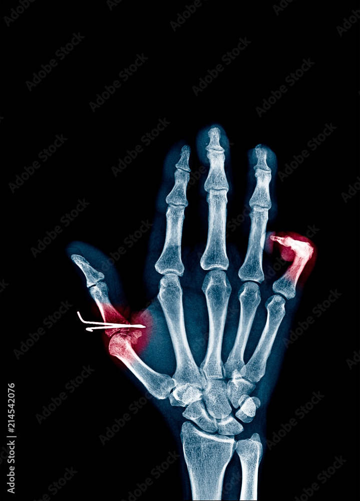 Xray image of hand and fingers show fracture at Thumb and little