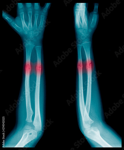 X-ray image of Forearm bone fracture in child's (Radius bone, Ulna bone) © Choo