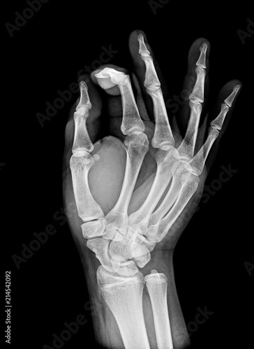 X-ray image of normal Hand , xray medical background.