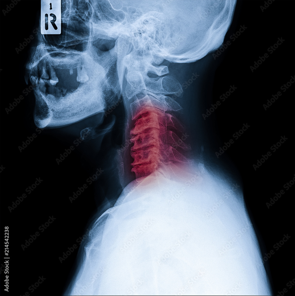 Xray of neck and cervical spine side view. Image of radiography from