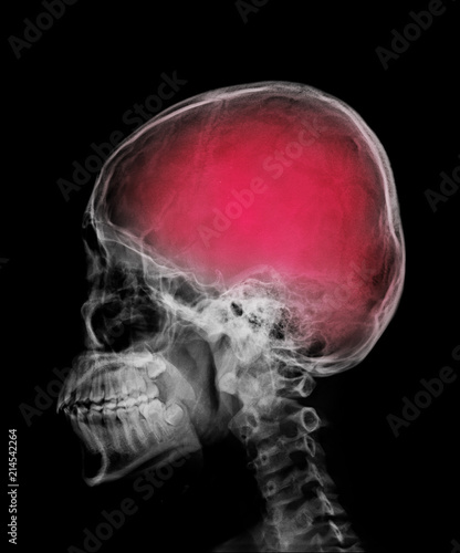 head skull x-ray side view and area of brain show in red color