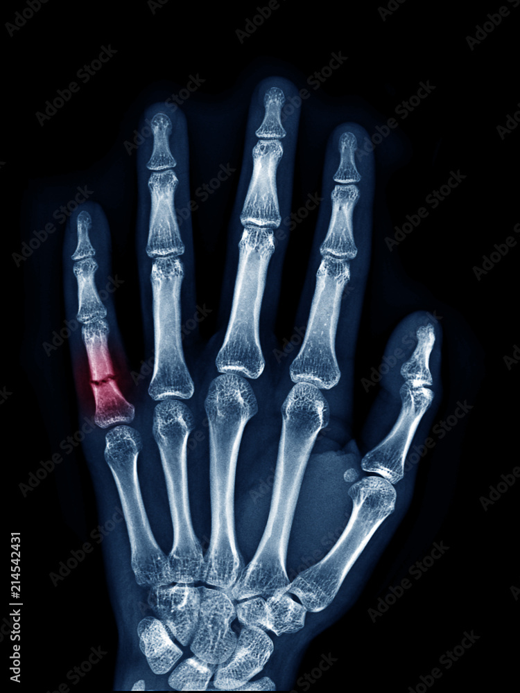 X-ray image of left hand show fracture at little finger upper view , area of broken with red color mark X-ray image of left hand show fracture at little finger upper view , area of broken with red color mark
