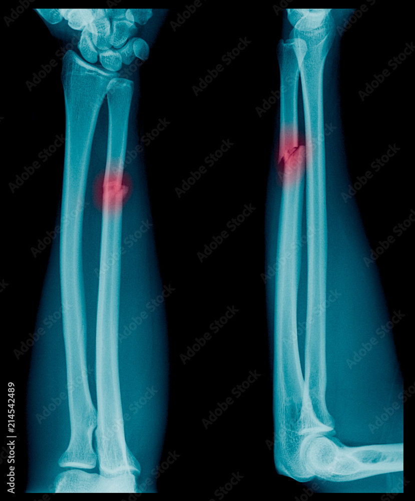 X-ray image of Forearm bone fracture in child's (Radius bone, Ulna bone) X-ray image of Forearm bone fracture in child's (Radius bone, Ulna bone)