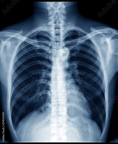 Chest x-ray of normal healthy man show lung, heart, spine, clavicle, diaphragm