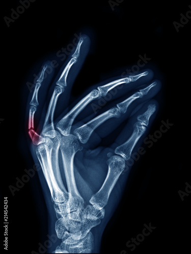 X-ray image of left hand show fracture at little finger oblique, side view , area of broken with red color mark