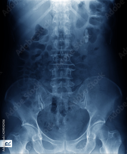 x-ray image of human normal spine, rips, pelvis, both hip joint