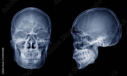Very good quality X-ray image of normal human skull front (AP) view and side (Lateral) view, Process in blue tone isolated on black background. photo