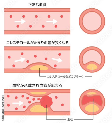 動脈硬化の進行