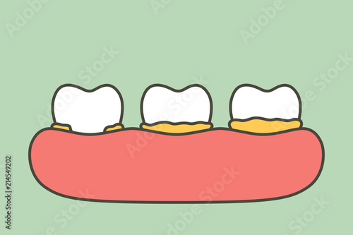 step of plaque or tartar , cause of tooth periodontal disease - dental cartoon vector flat style
