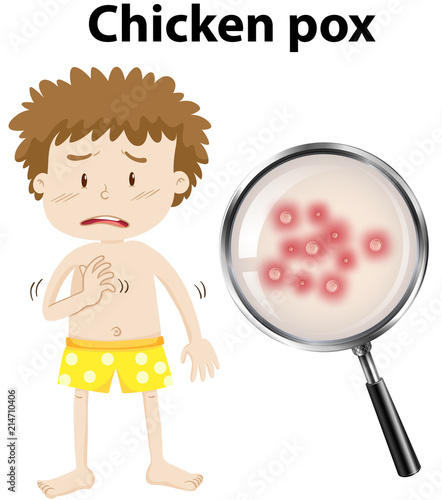 A young kid with chicken pox