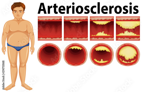 A fat man with atherosclerosis