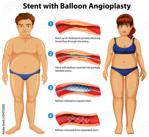 Stent with balloon angioplasty