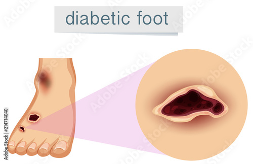 A human foot with diabetic