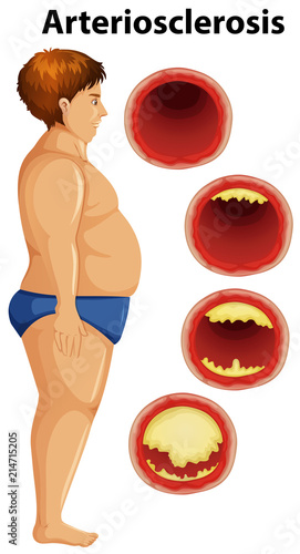 Fat man and arteriosclerosis