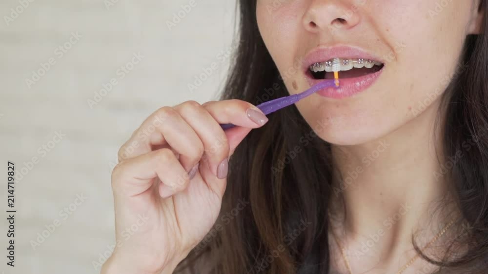 Oral hygiene for braces. Young girl with dental braces cleans her teeth. Teen girl cleaning and brushing teeth with clear ceramic braces using special brushing tools. Oral hygiene for braces. Young girl with dental braces cleans her teeth. Teen girl cleaning and brushing teeth with clear ceramic braces using special brushing tools.