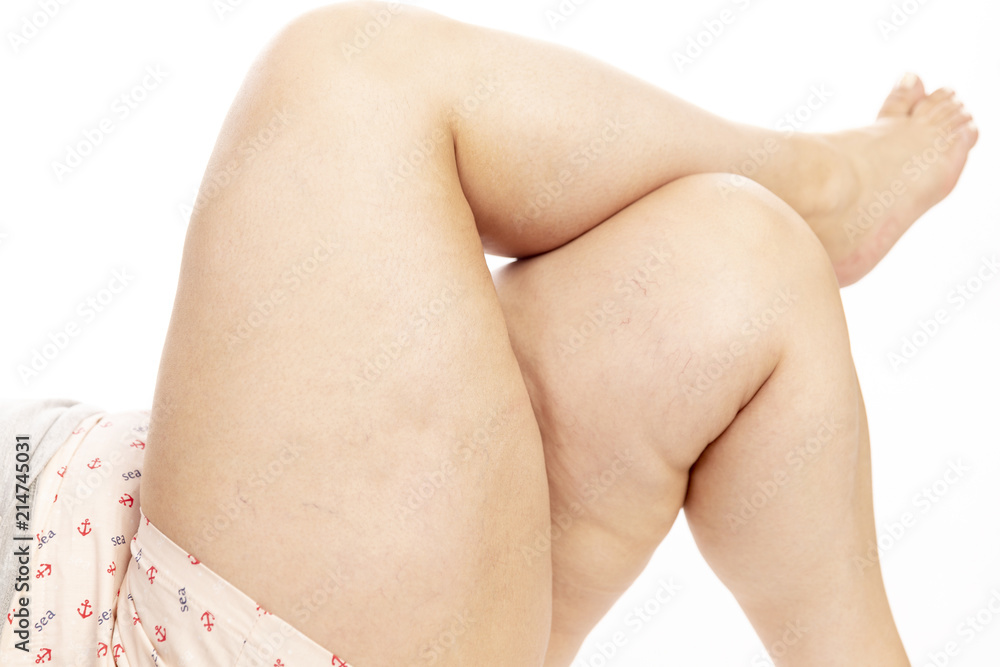 Legs of a fat woman with cellulite, isolated on white background Stock  Photo | Adobe Stock