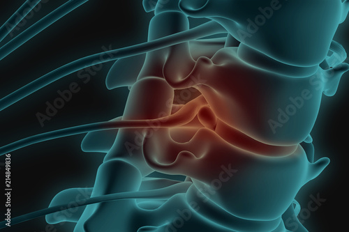 X-ray 3d image of cervical spine with prolapse of intervertebral disc compressive nerve root