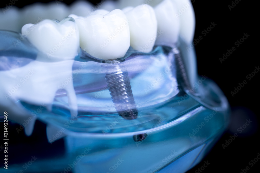 Dentist dental teeth implant Dentist dental teeth implant