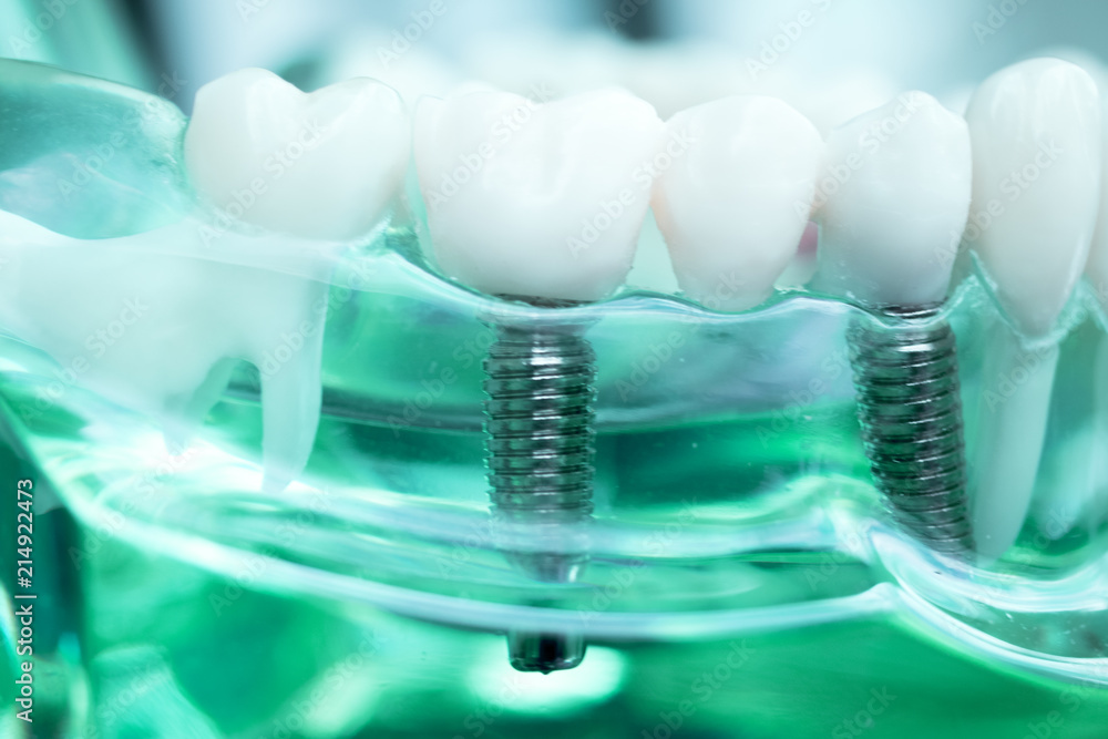 Dentist dental teeth implant Dentist dental teeth implant