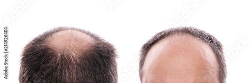 Foto circular hair loss at the back of the head and receding hairline at the front