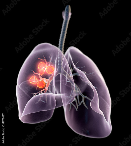 Lung cancer, medical illustration © Axel Kock