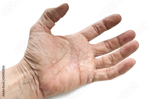 Psoriasis, skin disease on the joints of the body