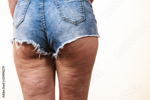 Woman legs with cellulite skin