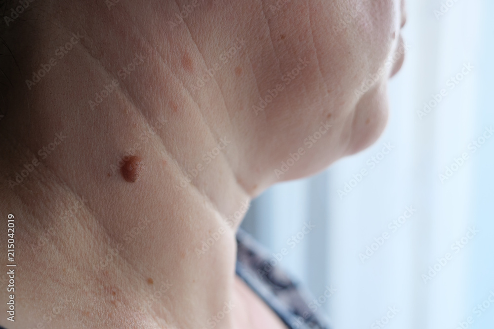 Adult woman with a large mole on her neck Adult woman with a large mole on her neck