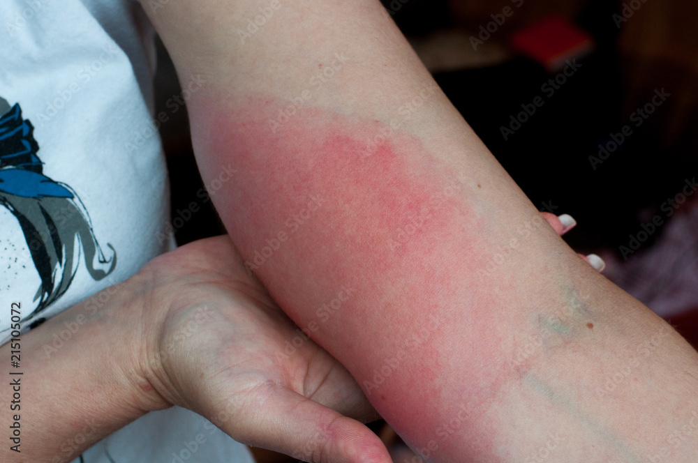 Wasp sting. Red swollen closeup. Skin allergy Stock Photo Adobe Stock