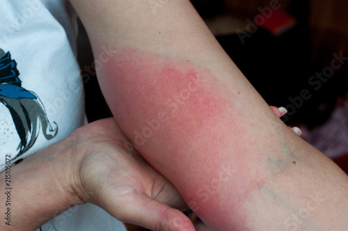 Wasp sting. Red swollen arm closeup. Skin allergy