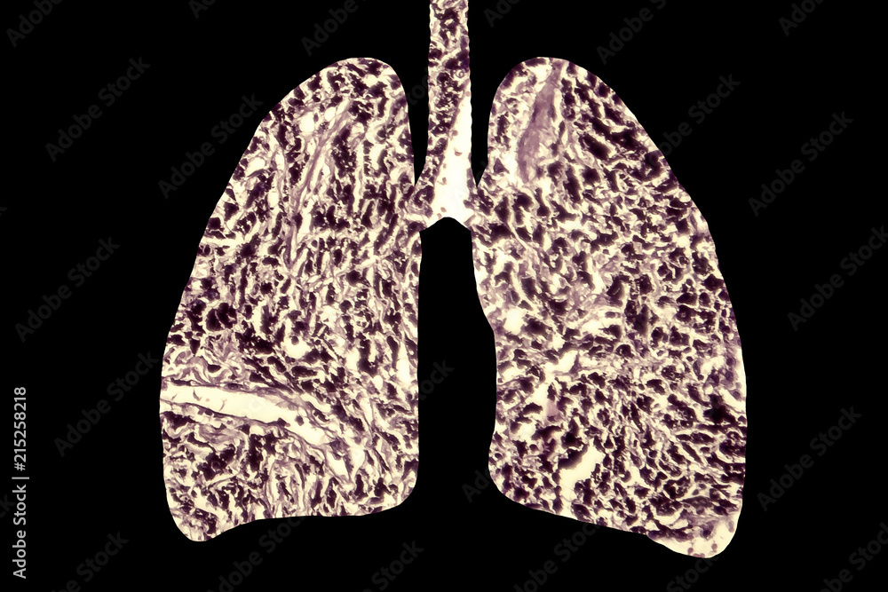 Smoker's lungs, medical concept, 3D illustration showing outline of lungs and light micrograph