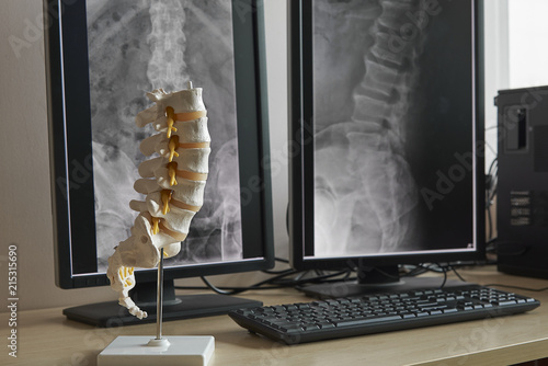 Human lumbar spine model and background of x-rays lumbar spine