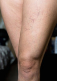 Ugly small veins are visible on the female leg.