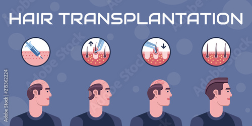 Hair transplantation steps