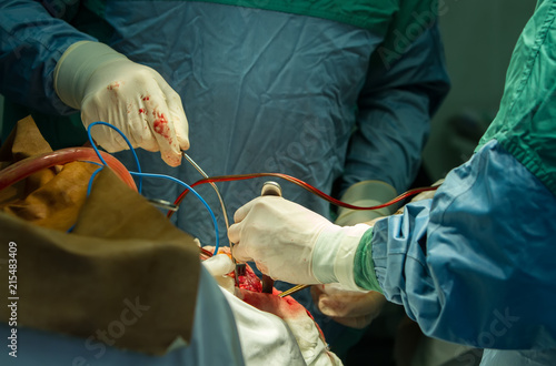 Close-up of the hands of surgeons holding pliers and suction, during trepanation of the skull.